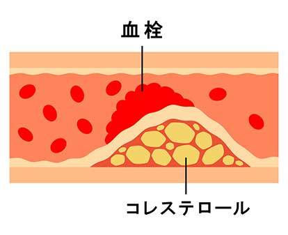 脂質異常症（高脂血症・低脂血症）