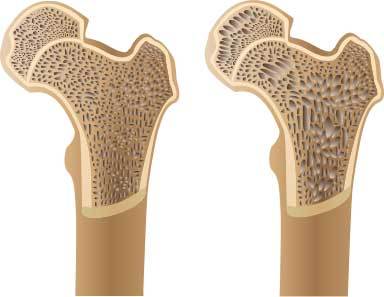 骨粗粗鬆症