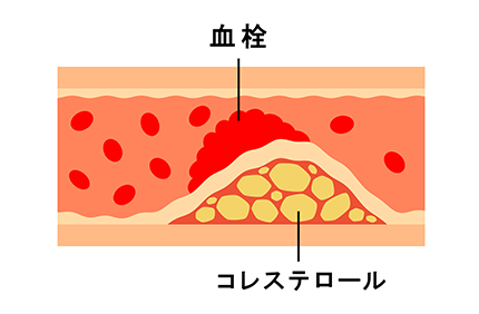 Lox-index®